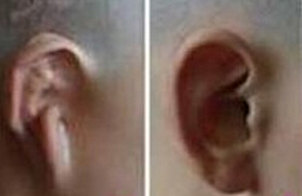 选择隐耳整形有什么优势呢？