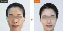 丰太阳穴手术的方法有哪些