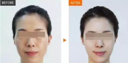 丰太阳穴手术的方法有哪些
