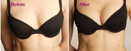 曼托假体隆胸有什么优势