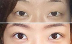 割双眼皮好还是埋线好 割双眼皮好还是埋线好