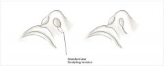 大鼻子该怎么整形呢 整形后会不会留下疤痕