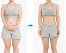 什么是水动力环形吸脂术，果好不好