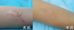 激光修复疤痕多久能见 激光修复疤痕多久能见