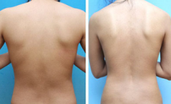 成都背部吸脂减肥多少钱呢