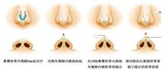 鼻小柱延长恢复时间要多久