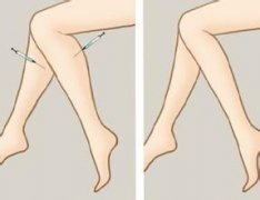 注射注射瘦腿会反弹吗