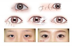 开眼角失败了怎么办呢，可以修复吗