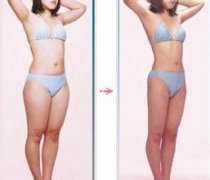 北京吸脂多少钱