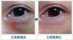 东莞去黑眼圈哪家整形医院好