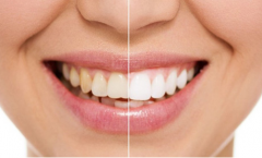 做一次冷光美白牙齿需要多少钱