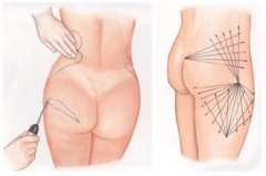 腰腹部瘦身选择吸脂还是溶脂好呢 腰腹部瘦身选择吸脂还是溶脂好呢