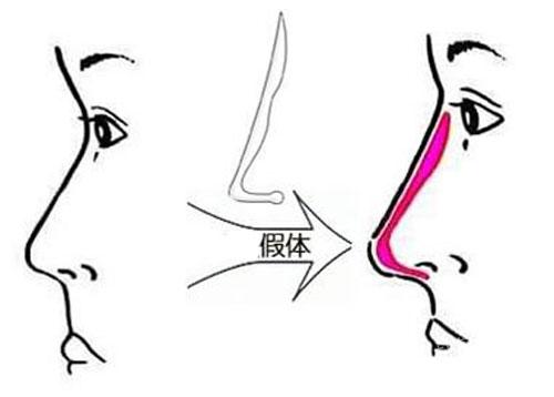 隆鼻,假体,取出,鼻子,恢复原貌