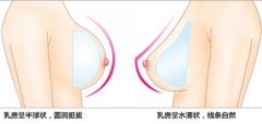 假体隆胸手术切口哪里Z降低风险