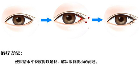 微创,开内眼角,留疤