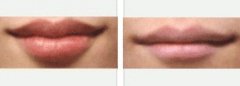 如何让嘴唇变薄