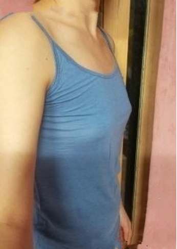 填充360cc硅胶假体隆胸手术后 穿吊带炒鸡性感