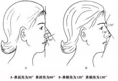 塌鼻子怎么变挺 塌鼻子怎么变挺
