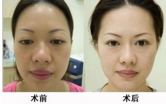 嘴巴大怎么变小