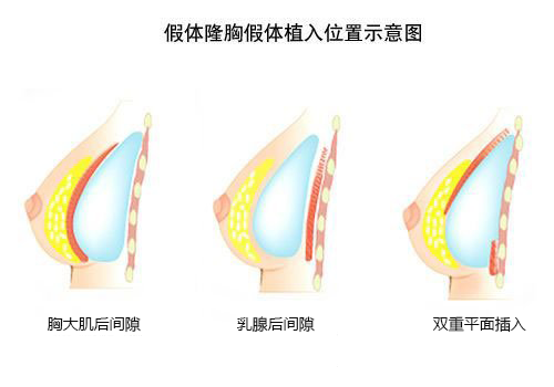 假体,隆胸,果,维持多久