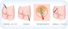 做臀部吸脂后皮肤会松弛吗 做臀部吸脂后皮肤会松弛吗