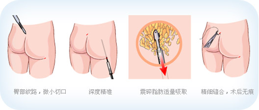 臀部,吸脂,皮肤,松弛