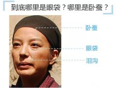 祛眼袋手术后如何才能恢复较快 祛眼袋手术后如何才能恢复较快