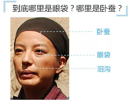 祛眼袋,手术,恢复较快