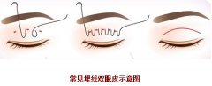 双眼皮手术价格表