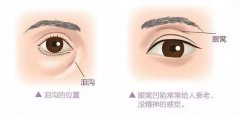 上眼窝凹陷怎么办