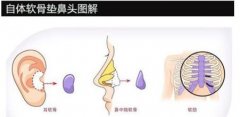 软骨隆鼻手术降低风险吗