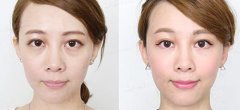 吸脂祛眼袋好不好会反弹吗