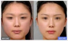 激光溶脂瘦脸的价格是多少 激光溶脂瘦脸的价格是多少