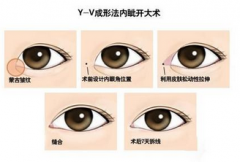 上海单眼皮开眼角可以吗
