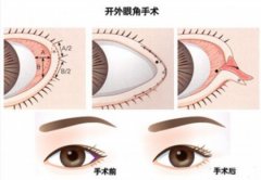 上海开内外眼角多少钱