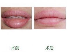 厚唇改薄术会留疤么