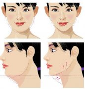 下巴吸脂多少钱