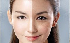 雀斑用什么方法可以祛除