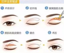 武汉双眼皮手术价格怎么样