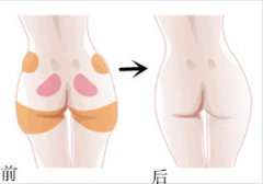 丰臀术的手术过程