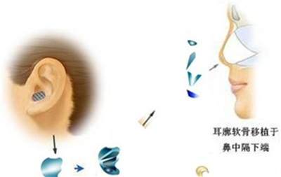 自体软骨,隆鼻,后遗症