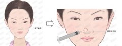 玻尿酸隆鼻为什么感觉疼肿