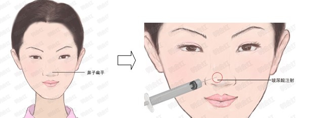 玻尿酸,隆鼻,疼肿