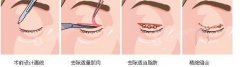 什么人不适合割双眼皮 什么人不适合割双眼皮