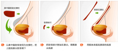 郑州假体隆鼻手术有副作用 郑州假体隆鼻手术有副作用