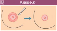 乳晕缩小术会伤到乳头吗