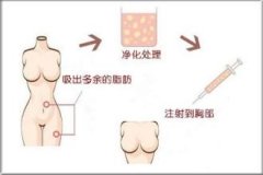 自体脂肪隆胸有危害吗 自体脂肪隆胸有危害吗