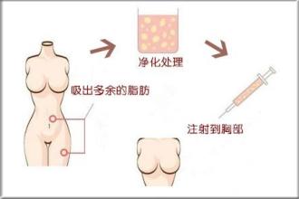 自体脂肪,隆胸,危害