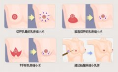 乳房缩小术怎么样 果好不好了 乳房缩小术怎么样 果好不好了