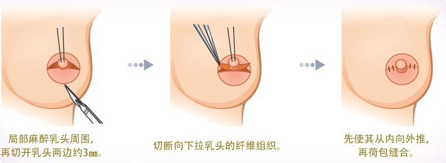 乳头内陷,乳头整形,缓解方法,原因